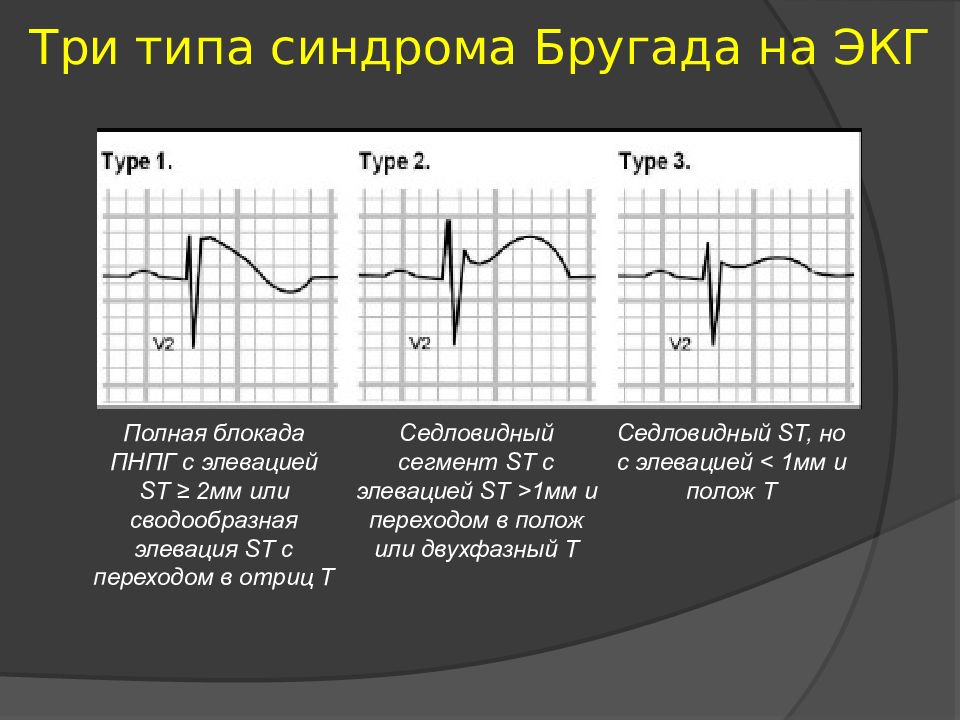 Синдром бругада презентация