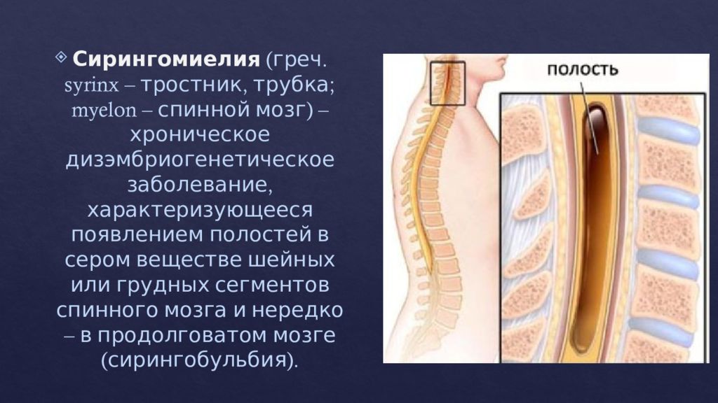 Сирингомиелия презентация по неврологии