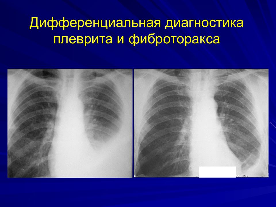 Фиброторакс
