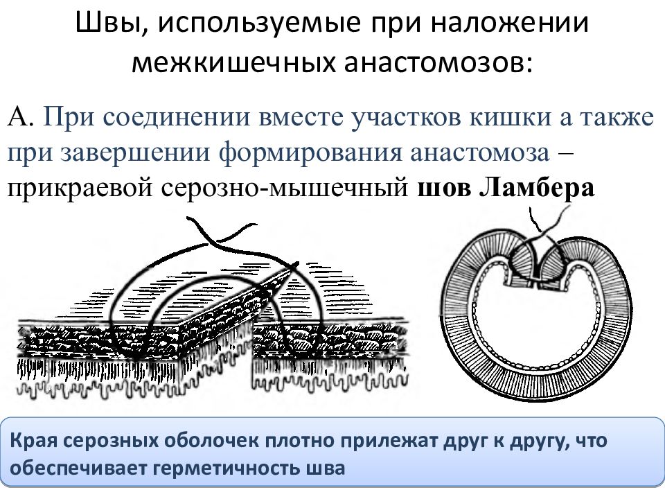 Кишечные анастомозы презентация