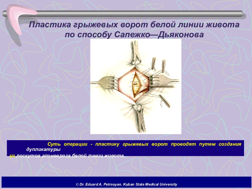 Пластика по сапежко