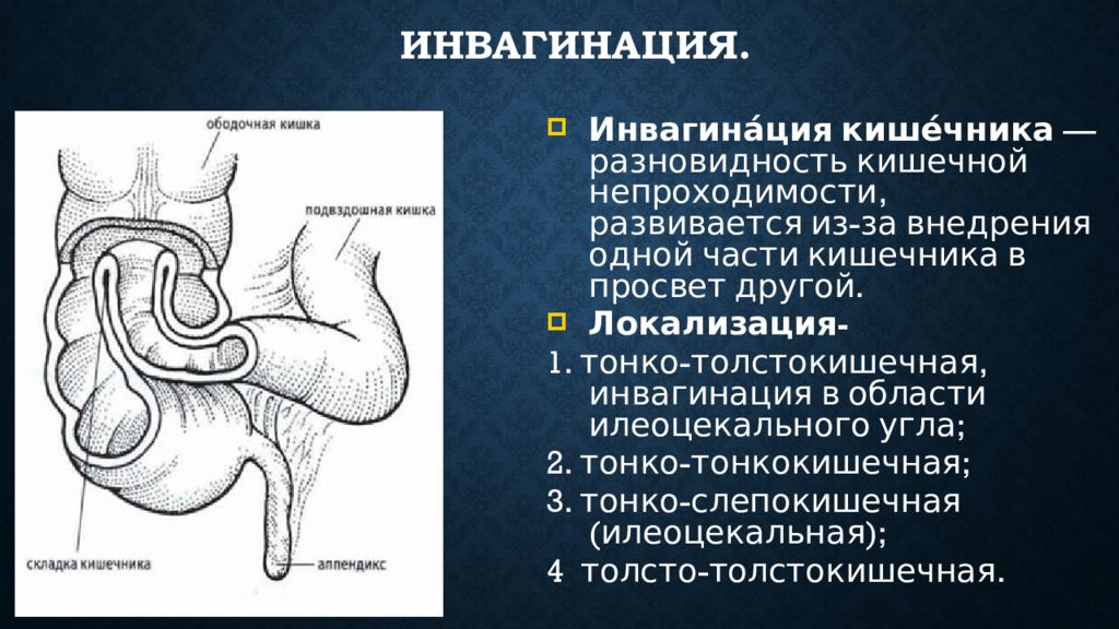 Симптомы непроходимости кишечника у взрослых. Илеоцекальная инвагинация кишечника. Инвагинация подвздошной кишки в слепую. Инвагинация при кишечной непроходимости. Инвагинация тонкой кишки у детей клинические рекомендации.