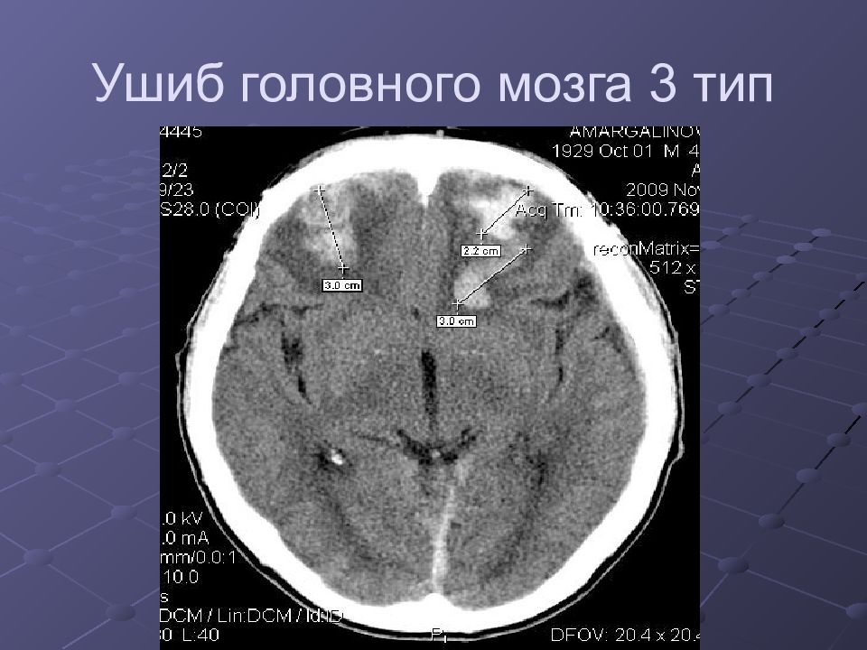 Организующая гематома