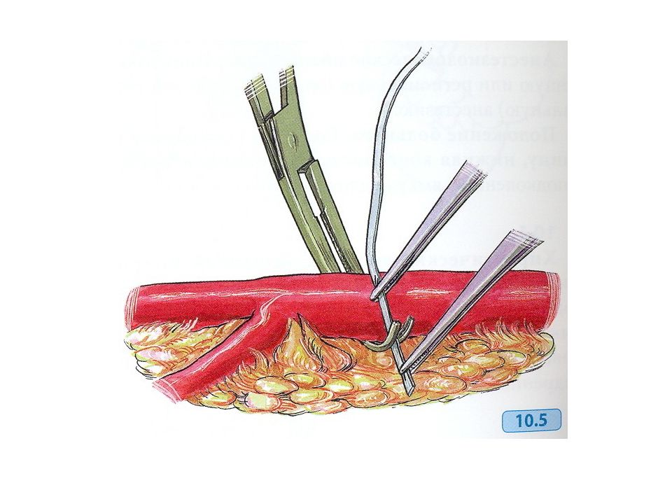 Перевязка в ране и на протяжении. Перевязка (лигирование) сосуда. Лигирование сосуда в ране и на протяжении. Лигирование бедренной артерии. Лигирование кровеносного сосуда.