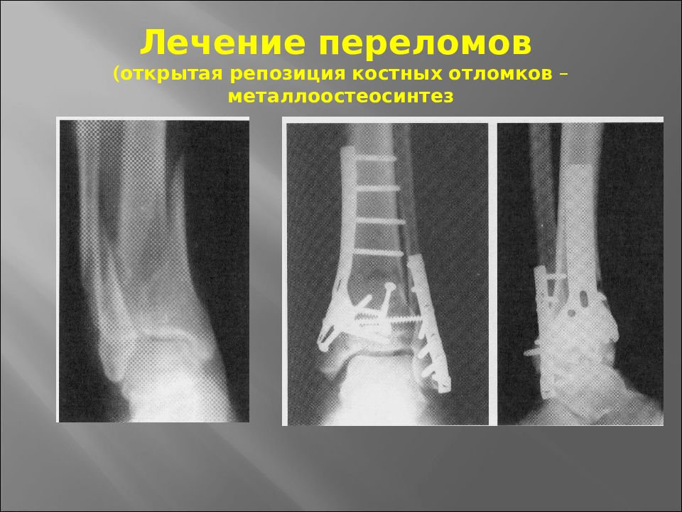 Переломы травматология презентация