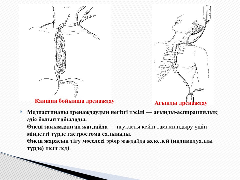 Тақырыбы: Іріңді медиастинит