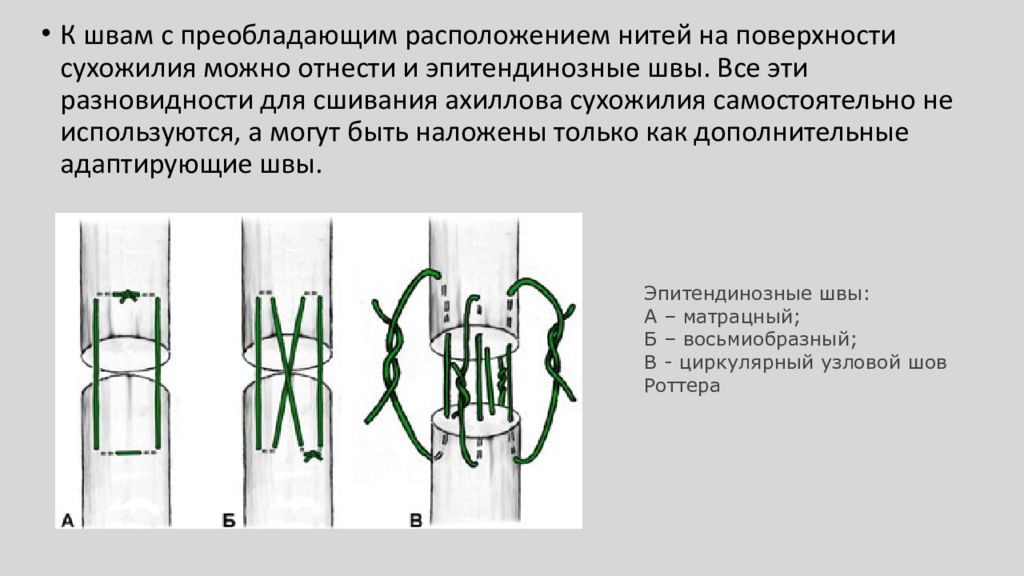 Жидкость шов. Эпитендинозный шов сухожилия. Сухожильный шов по Кракову. Шов Витцеля сухожильный. Матрацный шов сухожилия.