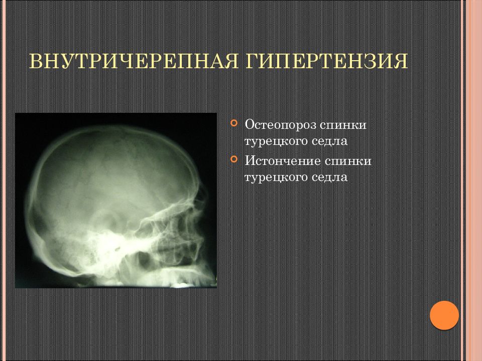 Вчг. Рентгенологические признаки внутричерепной гипертензии. Внутричерепное давление на рентгене черепа. Изменения турецкого седла на рентгене. Рентгенограмма турецкого седла.