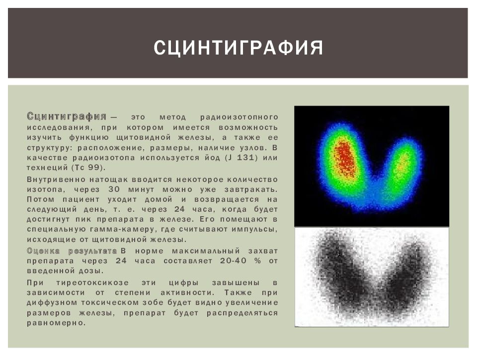 Изотоп почек. Сцинтиграфия при тиреотоксикозе. Радиоизотопное исследование (сцинтиграфия почек. Сцинтиграфия щитовидной железы контрастирование. Диффузный токсический зоб сцинтиграфия.