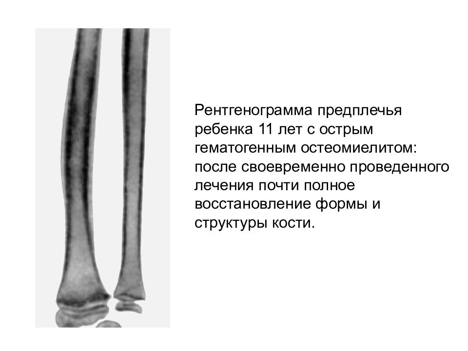 Остеомиелит у детей. Эпифизарный остеомиелит. Эпифизарный остеомиелит у детей. Остеомиелит предплечья рентген. Метафизарный остеомиелит.