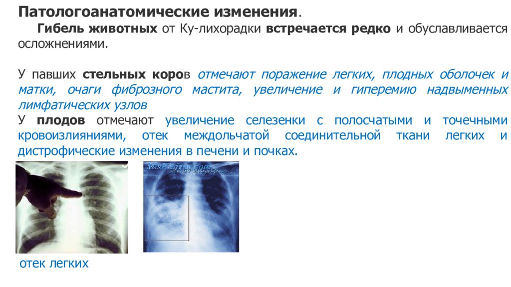 Клиническая картина лихорадки ку характеризуется