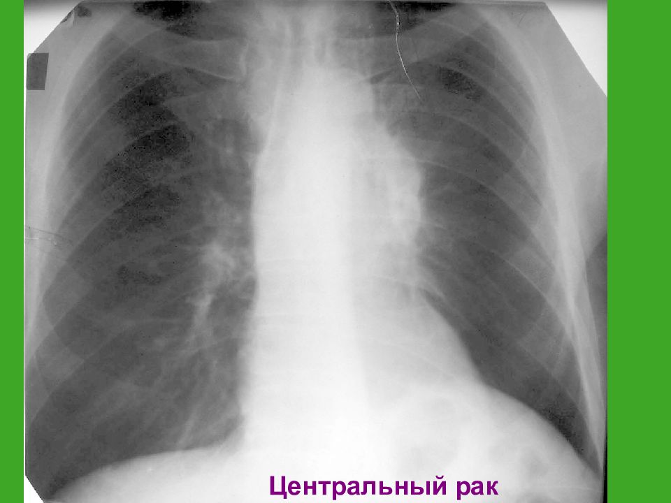 Центральный рак. 4. Рентгенологические признаки заболевания легких. Рентгенологические признаки ФБЛ легких. Рентгенологические признаки Ува.