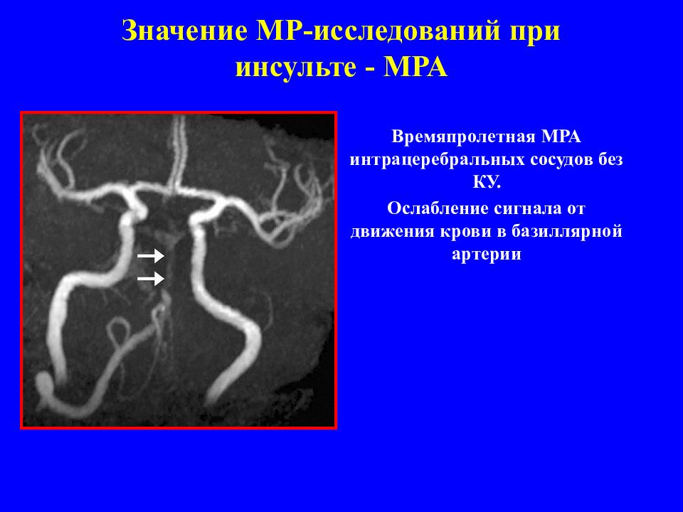 Мра артерий. Времяпролетная МР-ангиография. Инсульт на мрт ангиография. Интрацеребральнык артерии. Диагностическая информативность кт и мрт при инсульте.