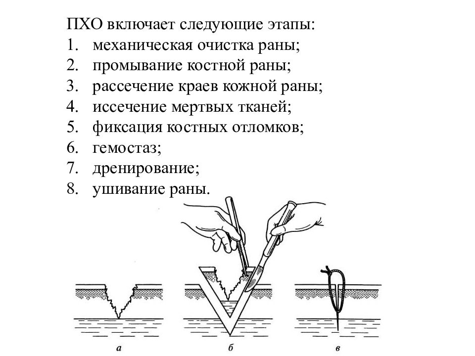 Пхо ран это. Первичная хирургическая обработка открытого перелома. Пхо открытого перелома. Этапы первичной хирургической обработки раны.