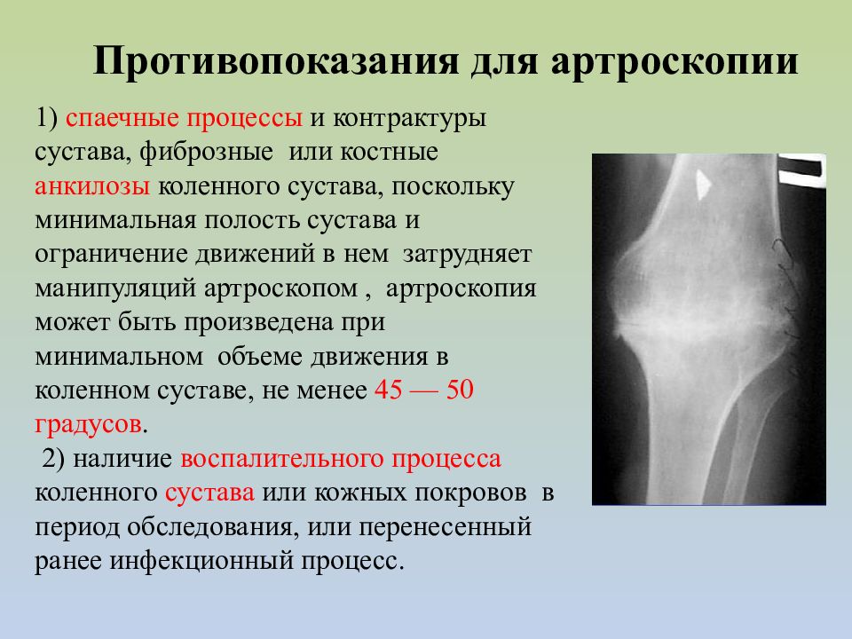 Повреждения коленного сустава травматология презентация