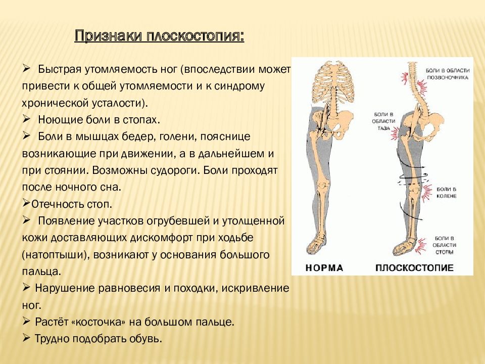 Плоскостопие травматология презентация