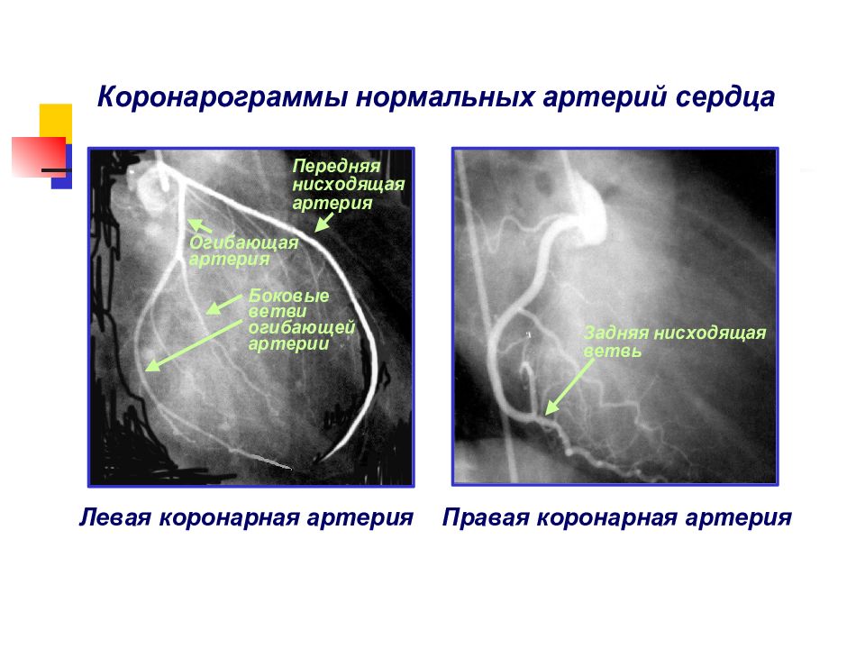 Презентация коронарные артерии