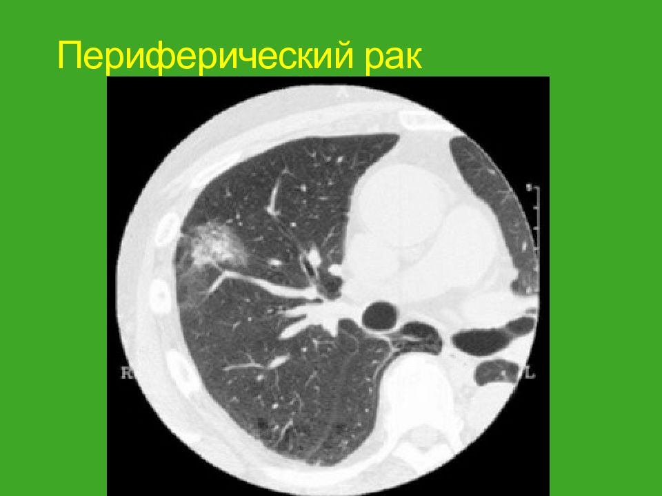 Периферический рак. Периферическое образование легкого на кт. Кальцификаты в легких кт.