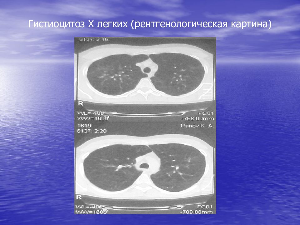 Гистиоцитоз х презентация