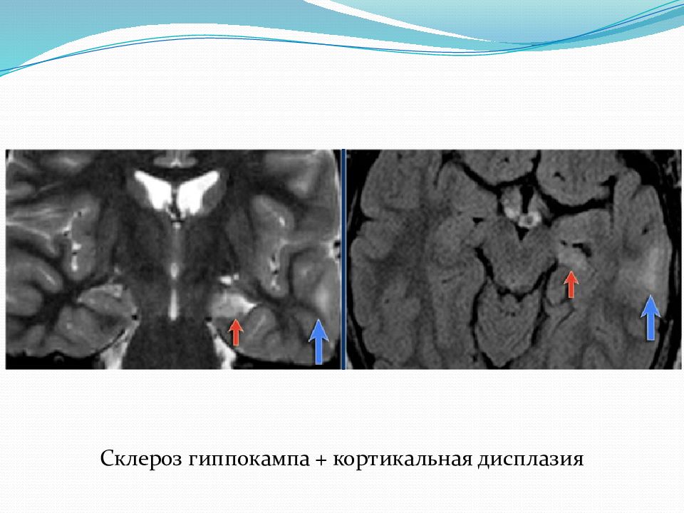 Кортикальная миоклония