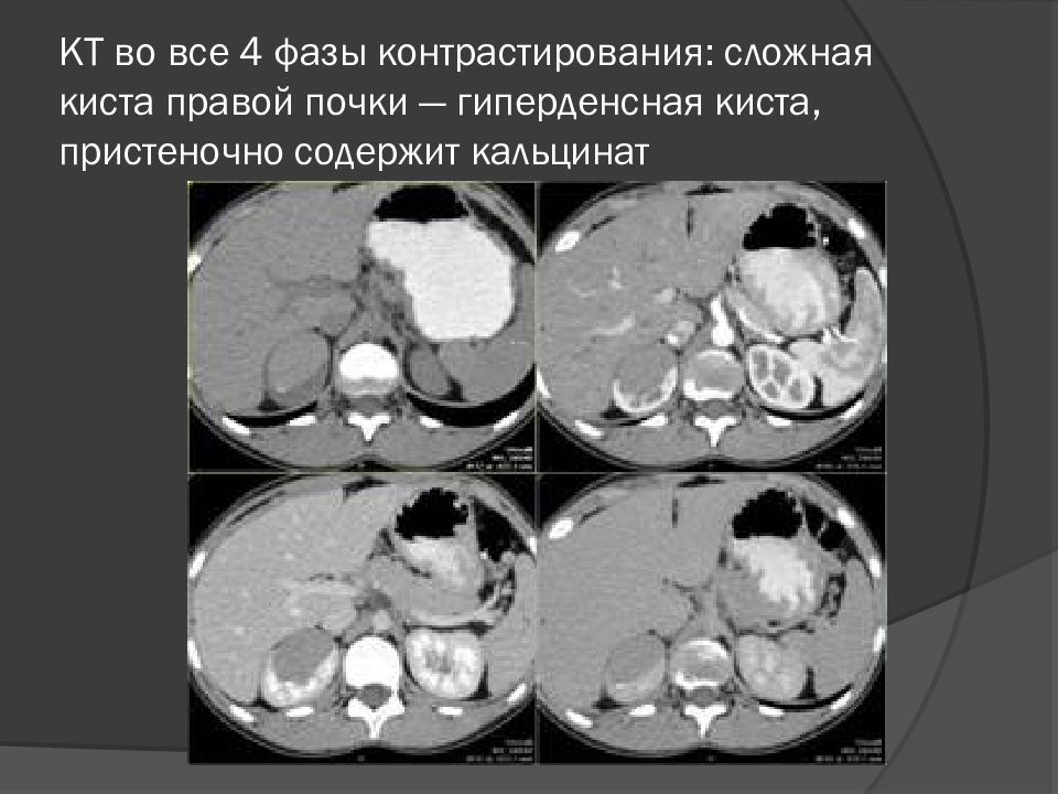 Кисты в печени и почках. Парапельвикальные кисты почек на кт. Мультилокулярная киста почки кт. Фазы контрастирования почек кт. Кисты по Босниак кт.