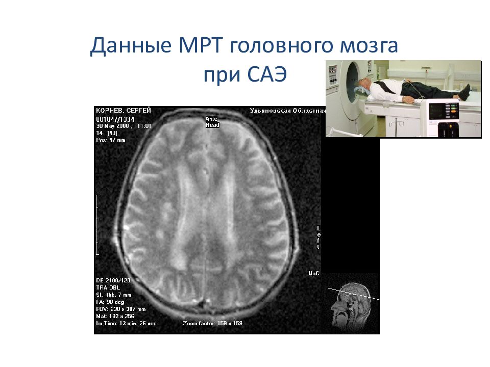 Перивентрикулярный лейкоареоз головного. Лейкоареоз мрт. Перивентрикулярный лейкоареоз. Перивентрикулярный лейкоареоз головного мозга что это такое. Перивентрикулярный линейный лейкоареоз.