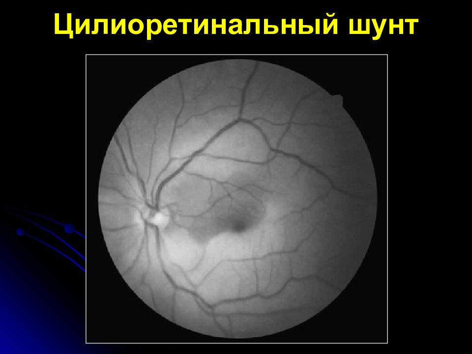 Возрастная макулярная дегенерация презентация