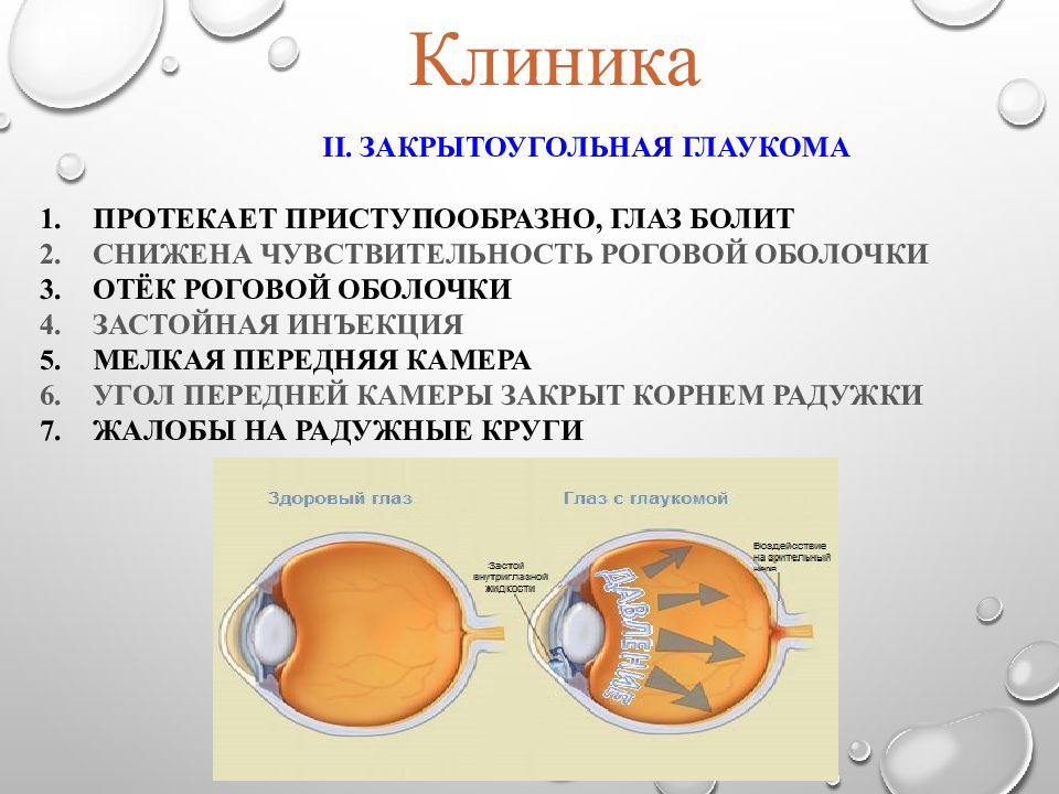 Для открытоугольной глаукомы характерны тест. Открытоугольная глаукома профилактика. Первичная открытоугольная глаукома симптомы. Первичная закрытоугольная глаукома клиника. Закрытоугольная глаукома приступ.