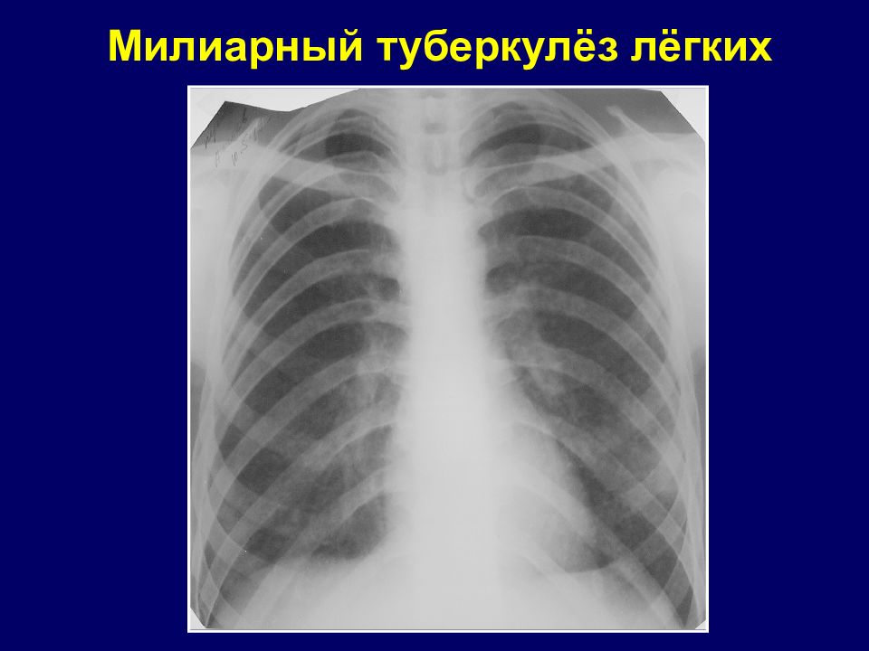 Появление туберкулеза. Милиарный диссеминированный туберкулез. Миллеальный туберкулёз.