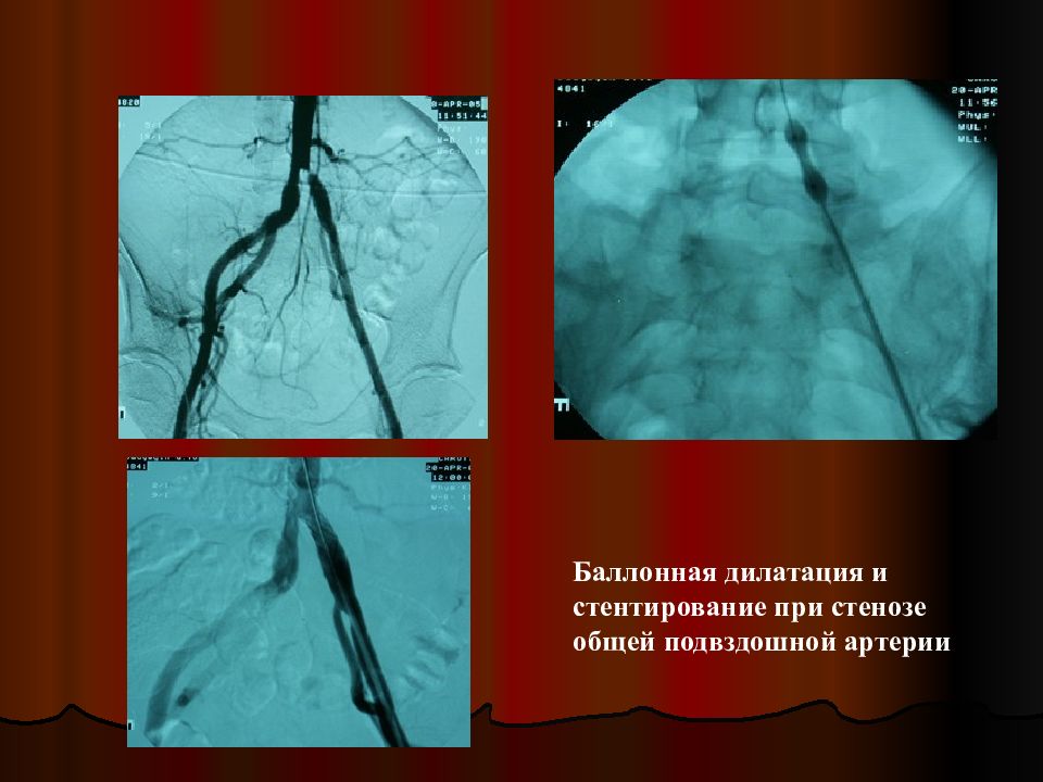 Эндоваскулярная окклюзия. Баллонной дилатации стентирование. Эндоваскулярная баллонная дилатация. Стентирования подвздошных артерий. Стентирование подвздошной артерии.