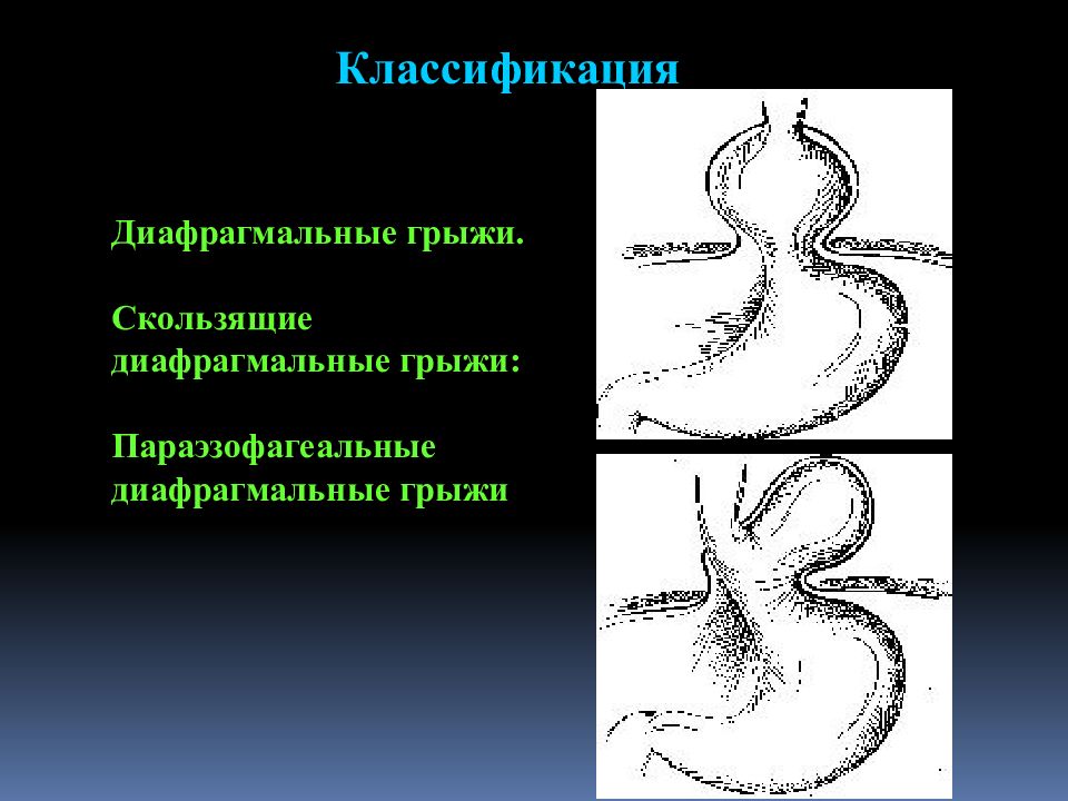 Скользящая грыжа. Параэзофагеальная диафрагмальная грыжа. Скользящая и Параэзофагеальная грыжа. Параэзофагеальные и скользящие грыжи пищевода. Диафрагмальные грыжи классификация.