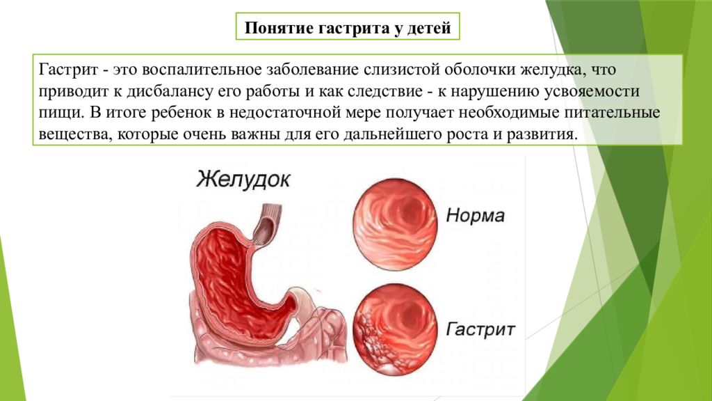 Гастрит у детей презентация