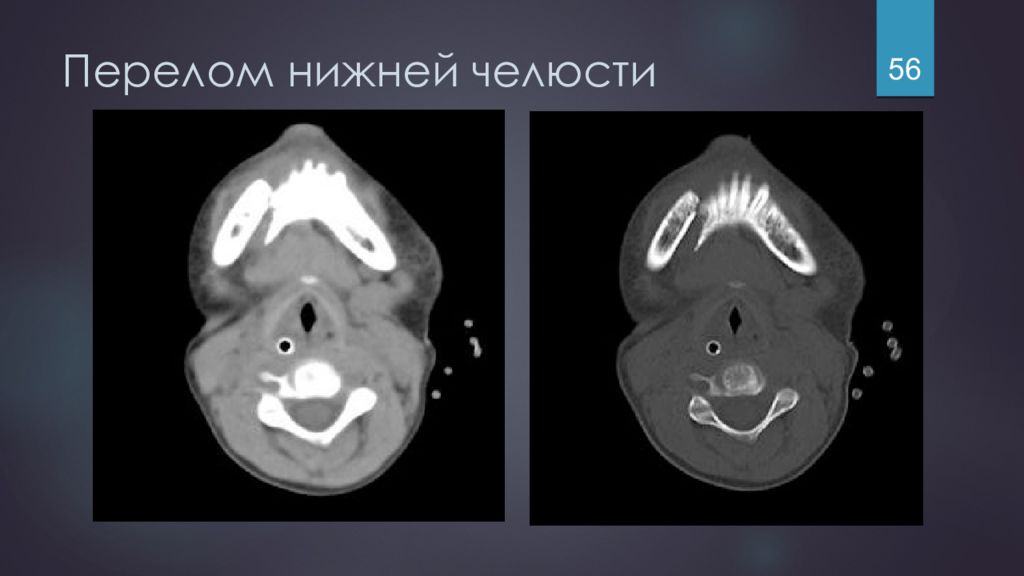 Комбинированные повреждения чло презентация