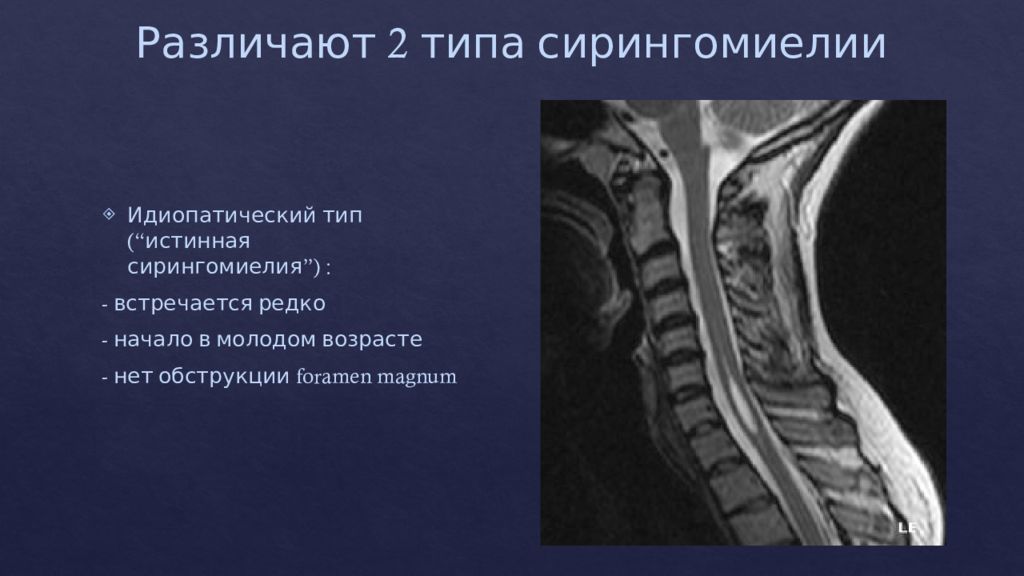 Сирингомиелия презентация по неврологии