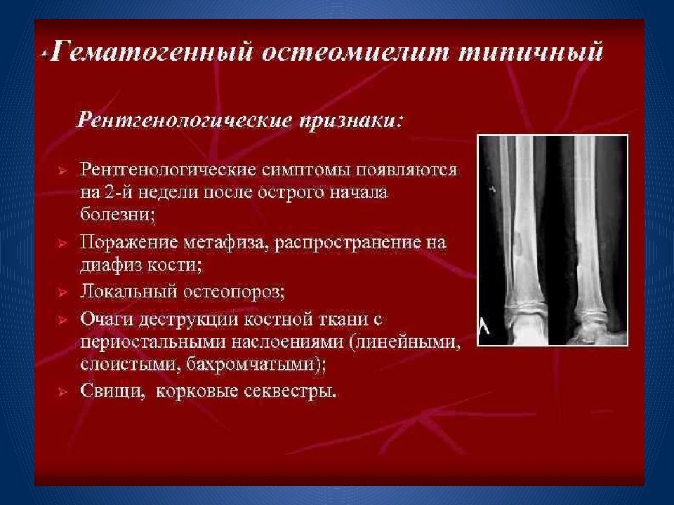 Вторичное поражение костей