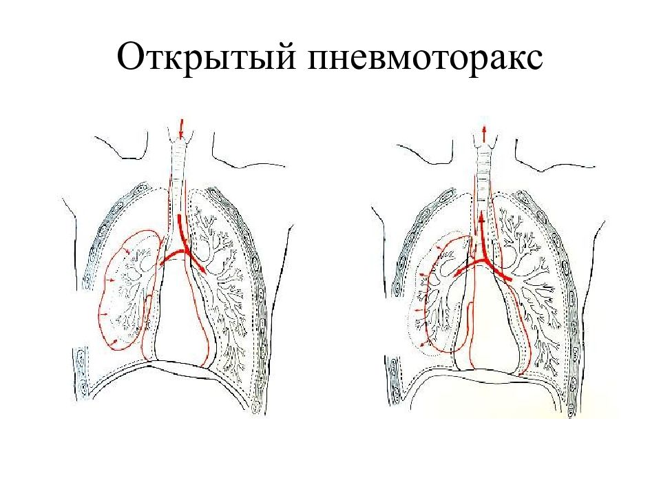 Закрытый пневмоторакс это