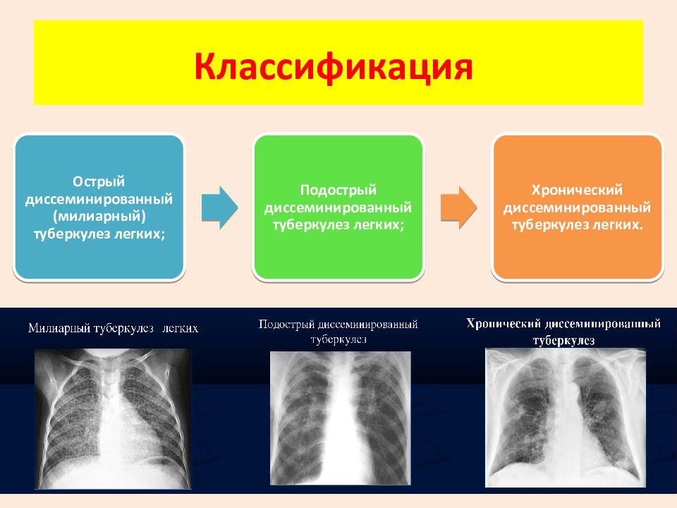 Возможные варианты развития клинической картины при туберкулезе легких