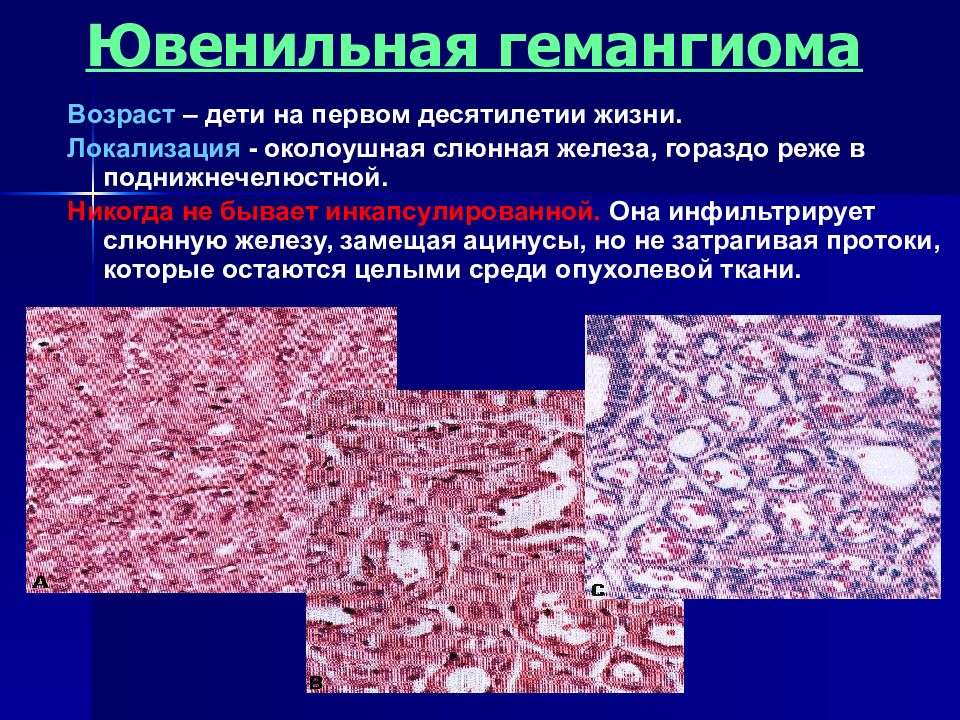 злокачественные опухоли слюнных желез, гемангиома околоушной железы, ацинус слюнной железы