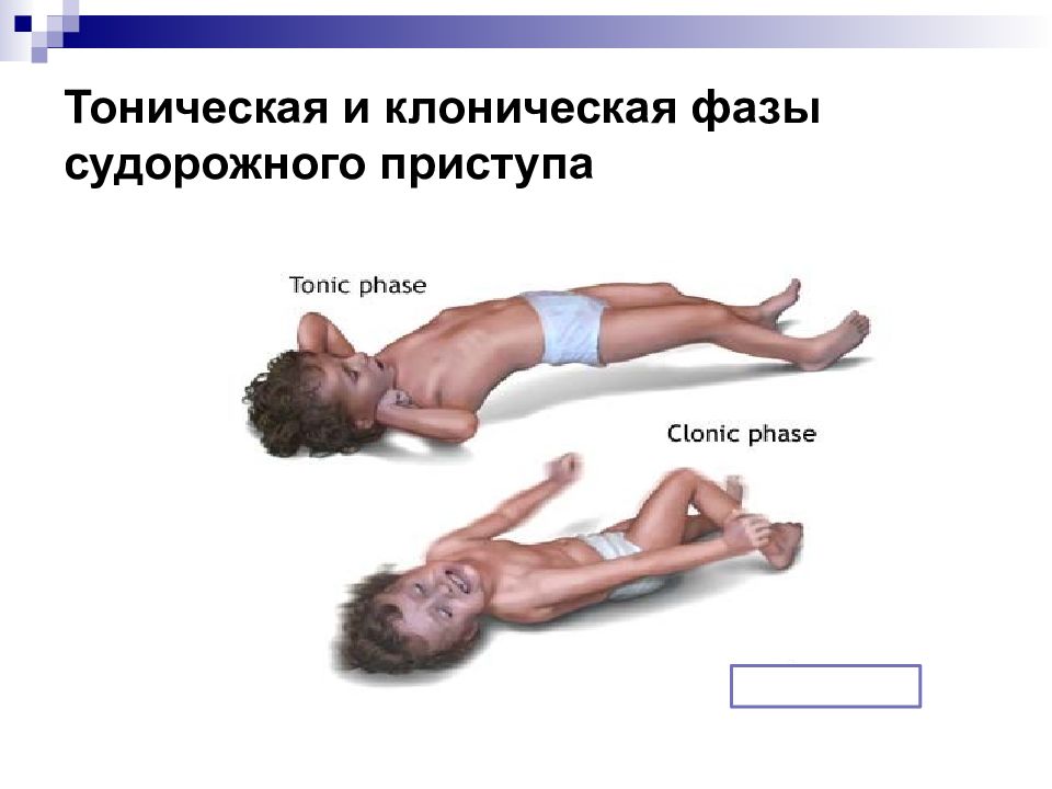 Клонические припадки. Тонические и клонические судороги у детей. Судорожный припадок тоническая фаза. Эпилепсия тонические и клонические судороги. Клонико-тонические судороги у новорожденных детей.