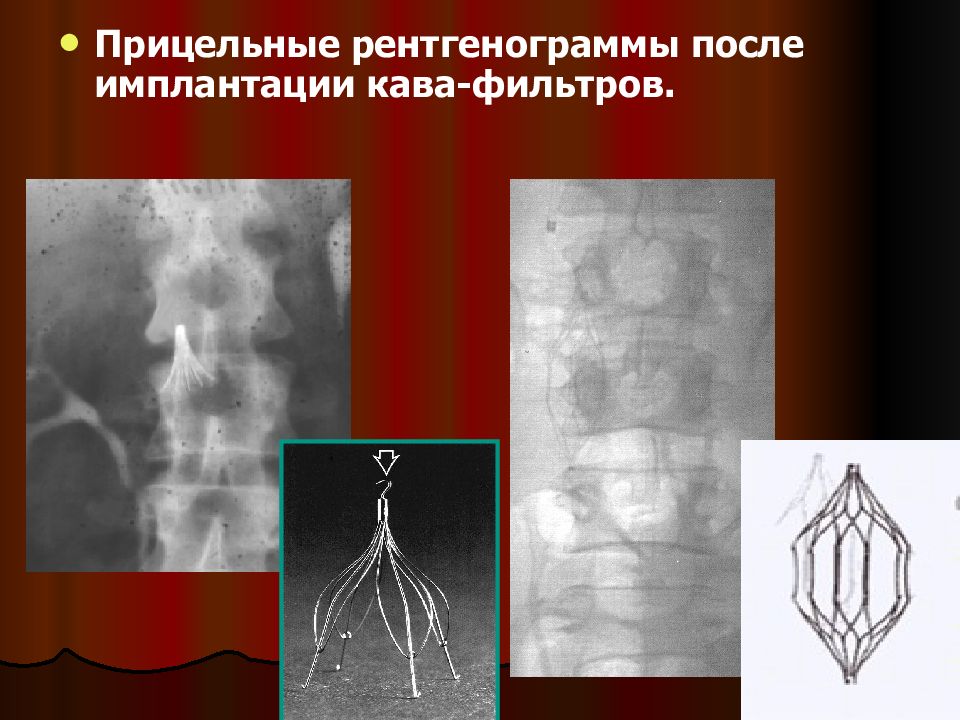 Интервенционная радиология презентация