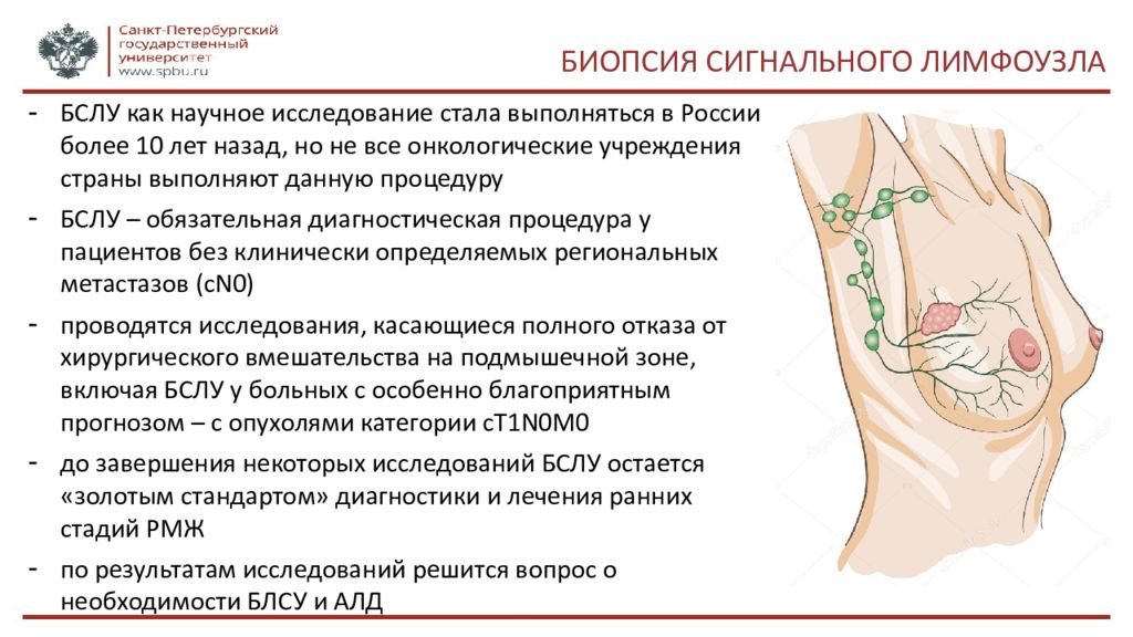 Сторожевой узел при раке молочной железы