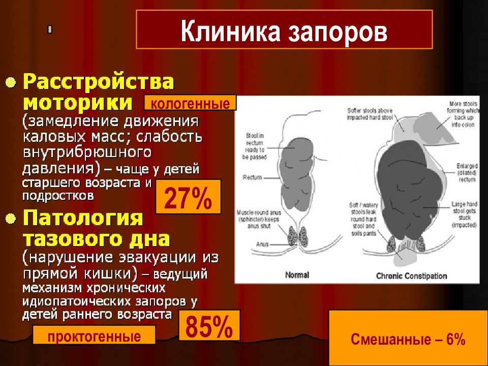 Запоры у детей презентация