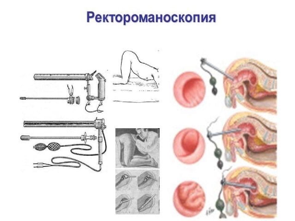 Как называется обследование прямой кишки. Прямая кишка ректороманоскопия. Исследование прямой кишки ректороманоскопия. Ректороманоскопия это метод исследования. Ректороманоскопия это исследование кишечника.