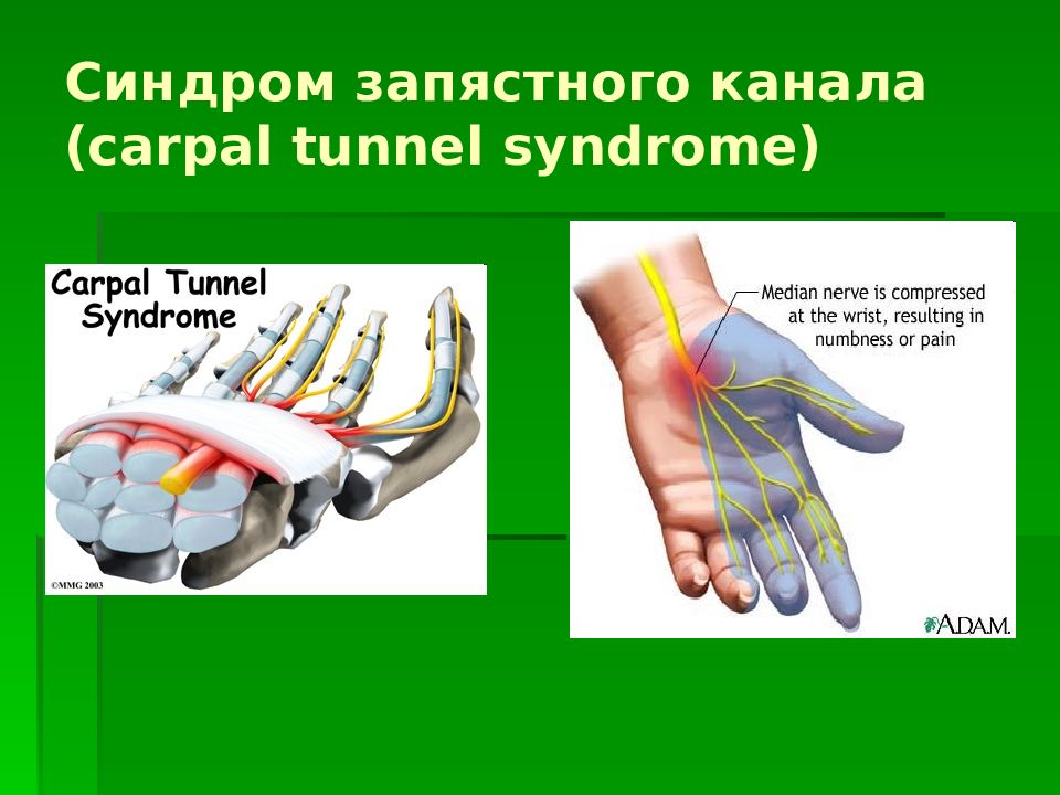 Синдром карпального канала мкб 10. Карпальный туннельный синдром. Туннельный синдром запястья кисти. Туннельный синдром запястного сустава. Карпальный синдром запястья.