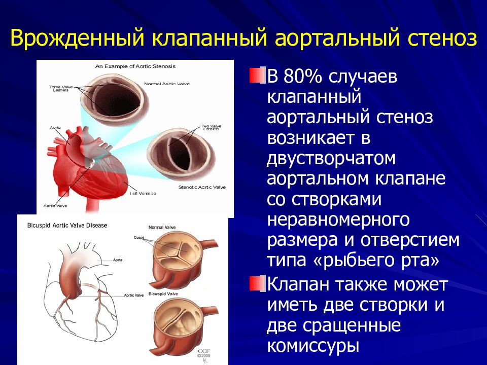 Аортальный клапан картинка