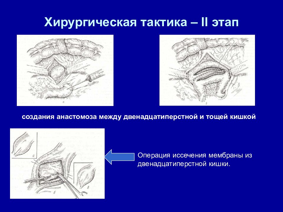 Врожденная кишечная непроходимость детская хирургия презентация