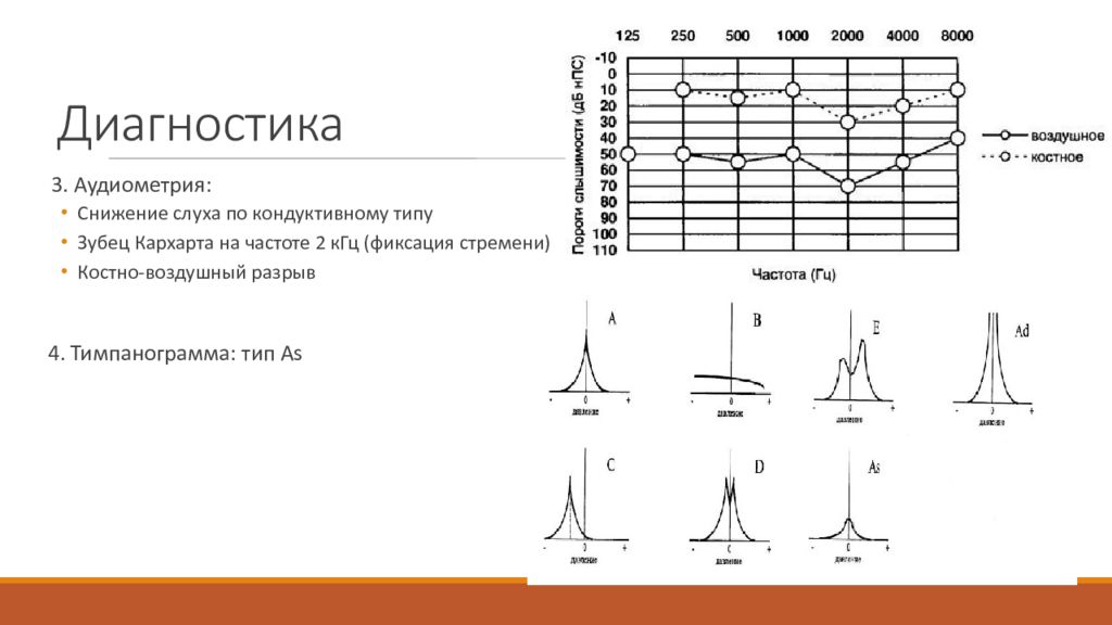 Типы тимпанограмм