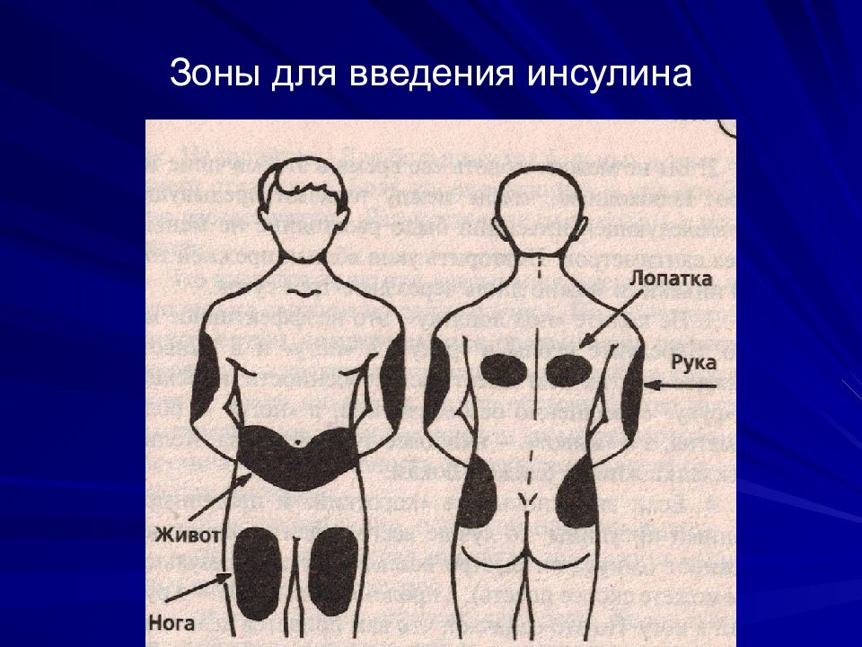 Место постановки. Места введения инсулина. Зоны инъекций инсулина. Зоны подкожного введения инсулина. Анатомические области введения инсулина.