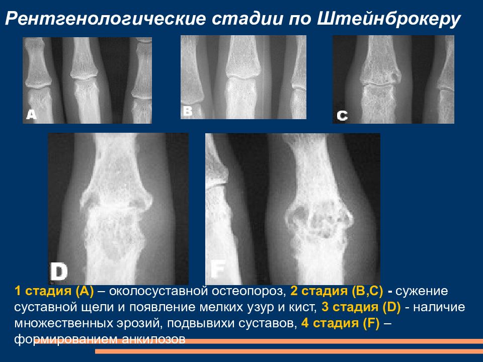 Ревматический полиартрит рентгенологическая картина