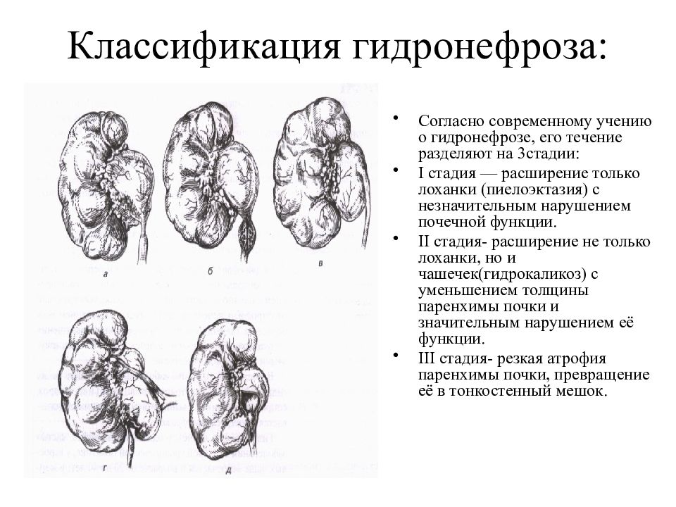 Гидронефроз у детей презентация